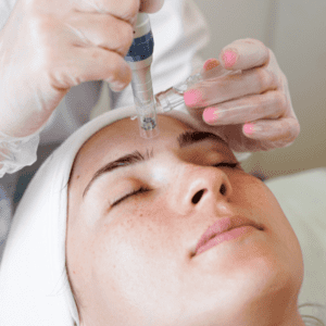 Microagulhamento com Drug Delivery
